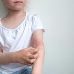 FDA Approves Zoryve Cream for Plaque Psoriasis in Children as Young as 2 Years