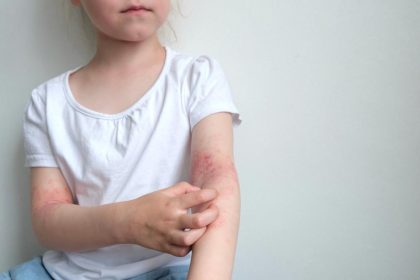 FDA Approves Zoryve Cream for Plaque Psoriasis in Children as Young as 2 Years