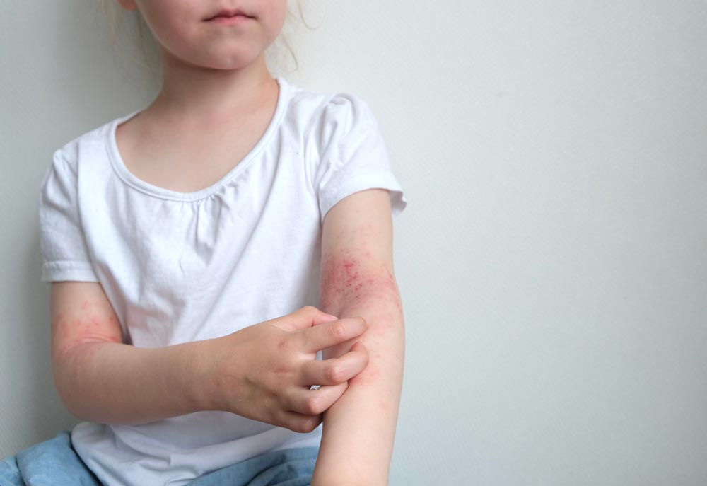 FDA Approves Zoryve Cream for Plaque Psoriasis in Children as Young as 2 Years